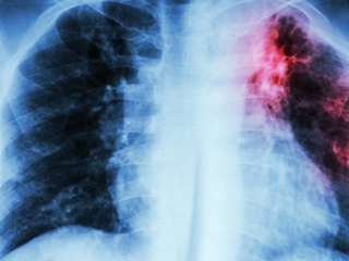 web-62-fibrosis-pulmonar