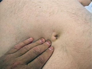 Hernia umbilical