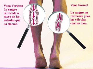 salud-Piernas varices-web