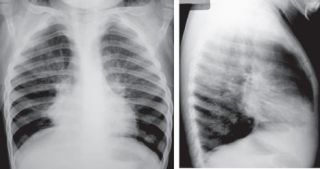 salud-bronquiolitis