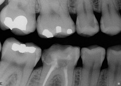 salud-caries-radiografia