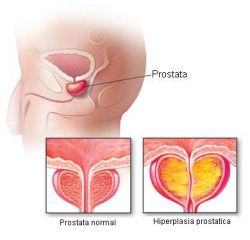 salud-prostata