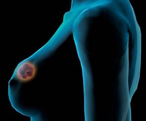 salud-cancer-mama