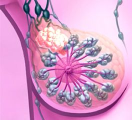 salud-Cancer-de-mama