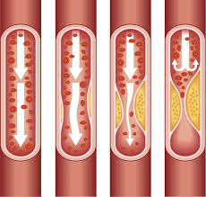 salud-arterioesclerosis