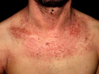 dermatitis-atopica2