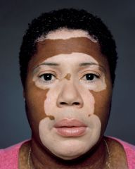 vitiligo