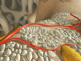 osteoporosis