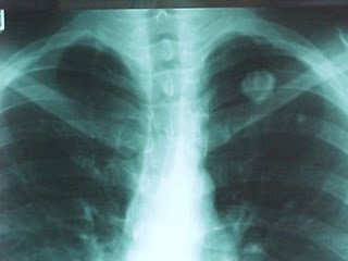 fibrosis