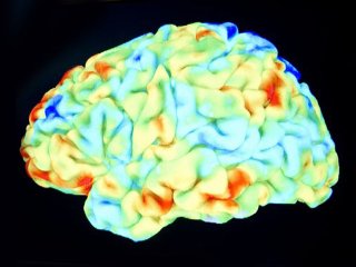 alzheimer