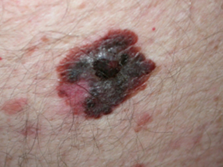  melanoma