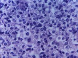 leucemia linfoblastica