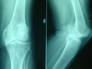 rodilla