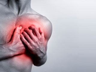 infarto