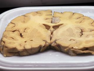alzheimer
