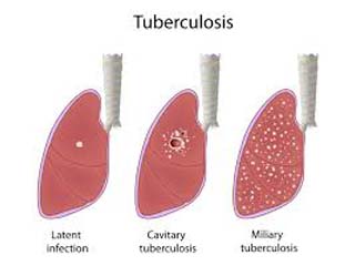 tuberculosis