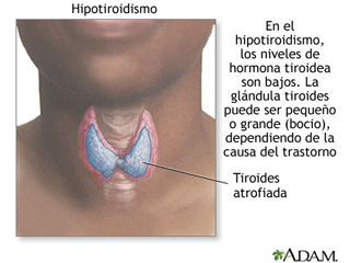 hipotiroidismo