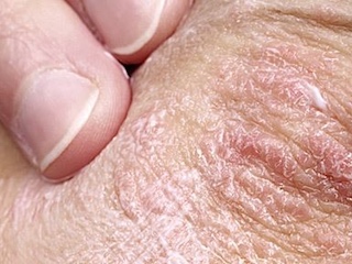 tecnologia-psoriasis-w