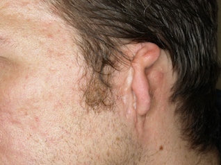 salud-bilateral-microtia-WB