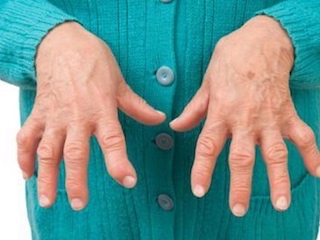 salud-Reumatologia-Artritis-WB