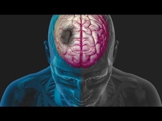 web-infarto-cerebral