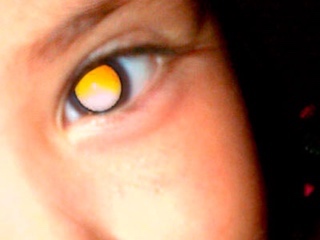 web-66-ciencia-retinoblastoma