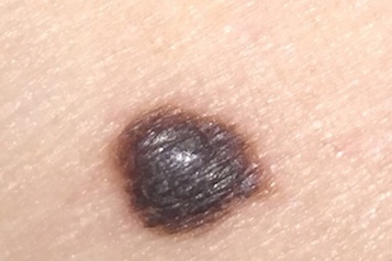 web-62-melanoma