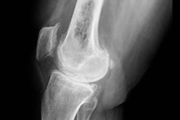web-62-osteosarcoma