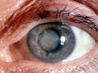 Cataratas Oculares